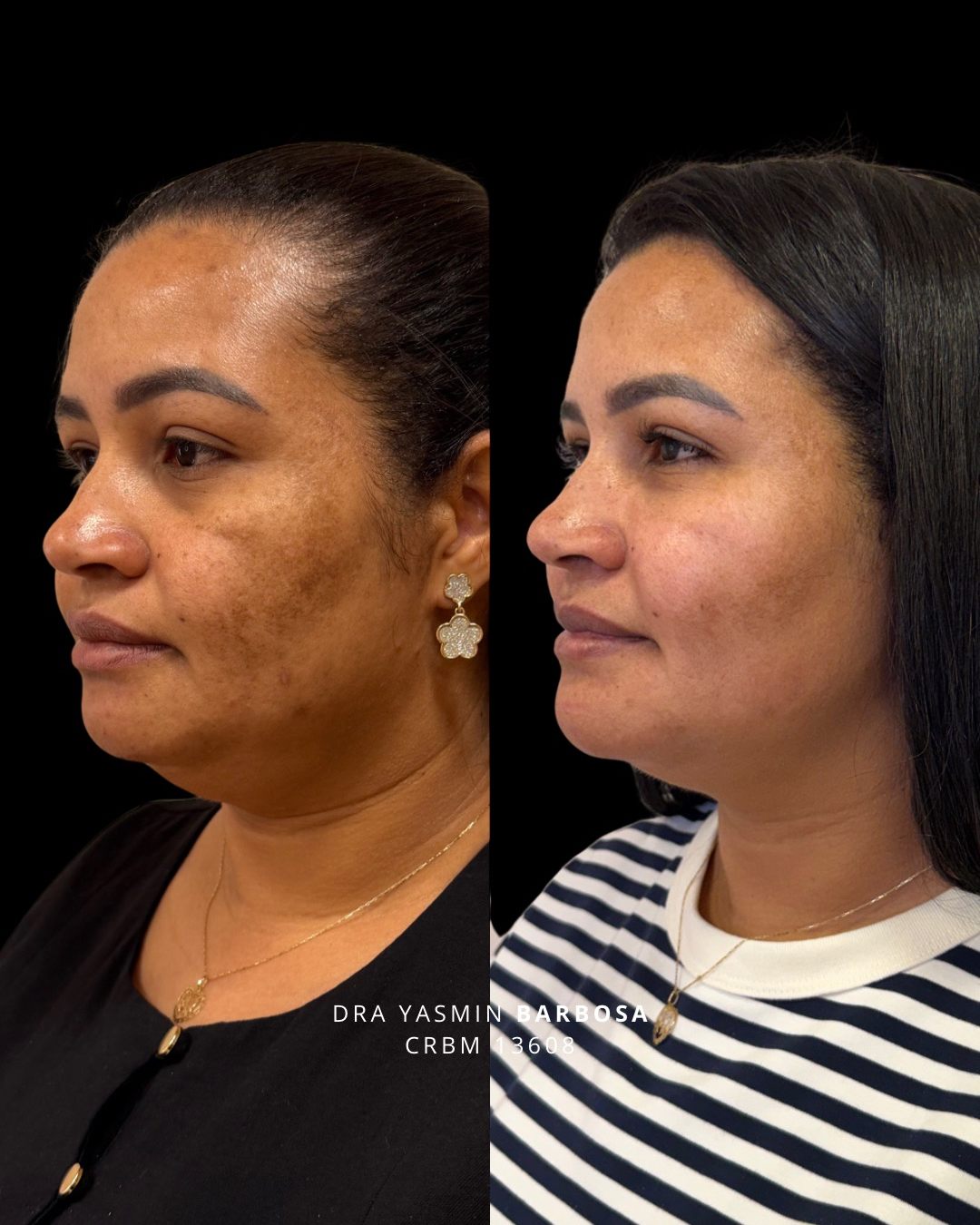 Paciente com melasma antes e depois do tratamento