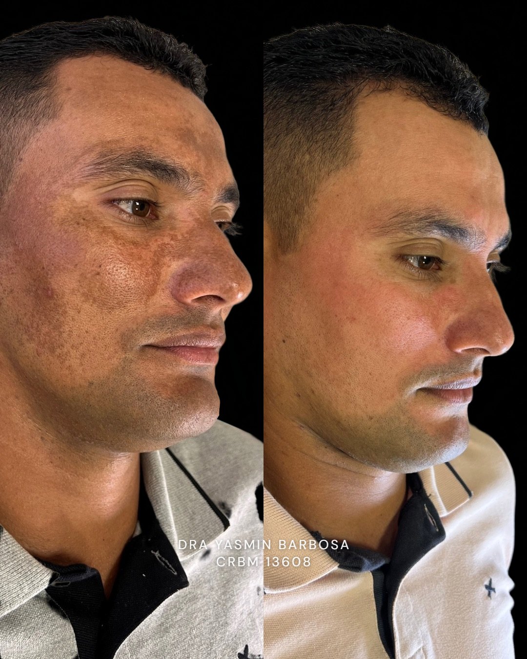 Paciente com melasma antes e depois do tratamento